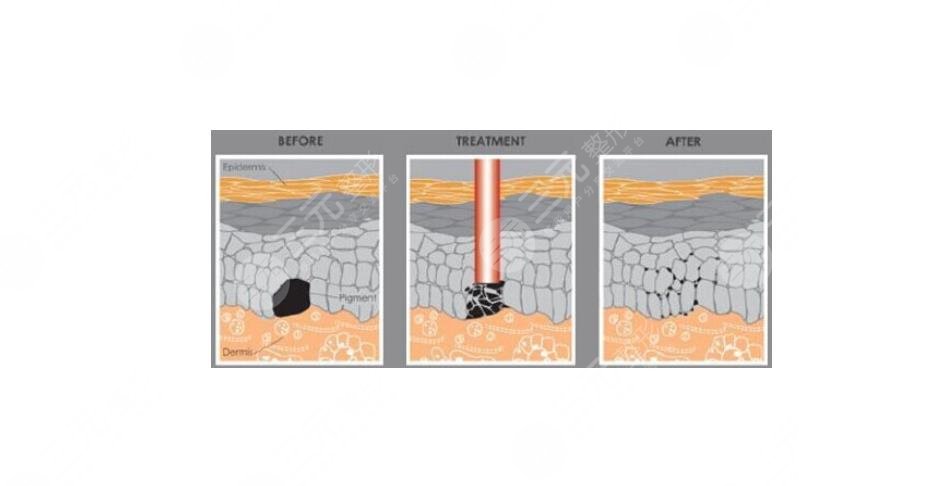激光祛疤的原理