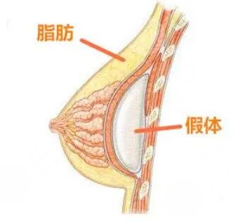 硅胶隆胸的优势有哪些?