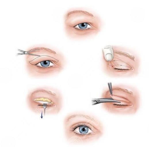 双眼皮整形手术方式有哪些