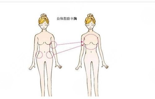 自体脂肪隆胸可以维持多长时间?