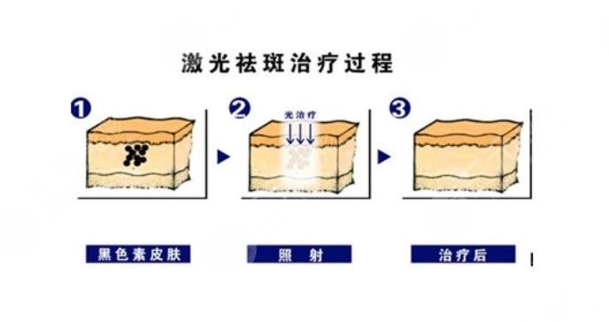 激光祛斑手术的原理