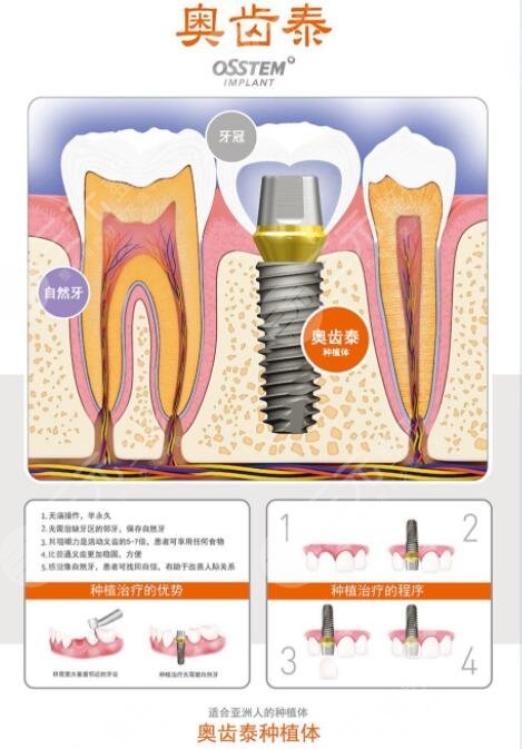 什么是牙齿种植?