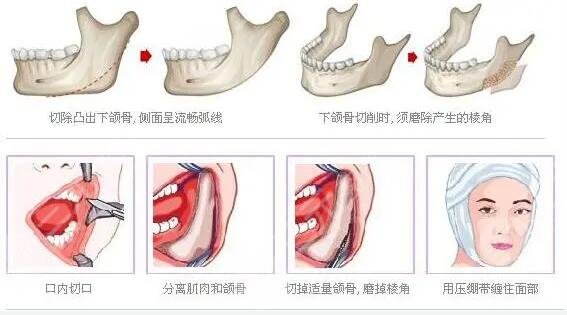 下颌角整形术后注意事项