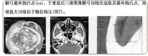  磨颧骨整形手术不是人群