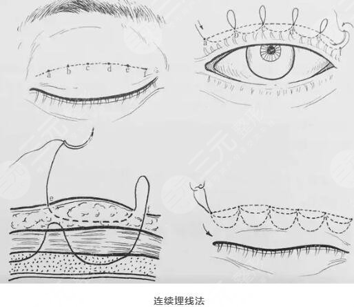 双眼皮果