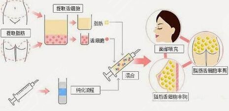 郑州地区自体脂肪填充项目科普