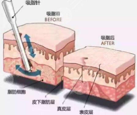 上海面部吸脂手术原理科普