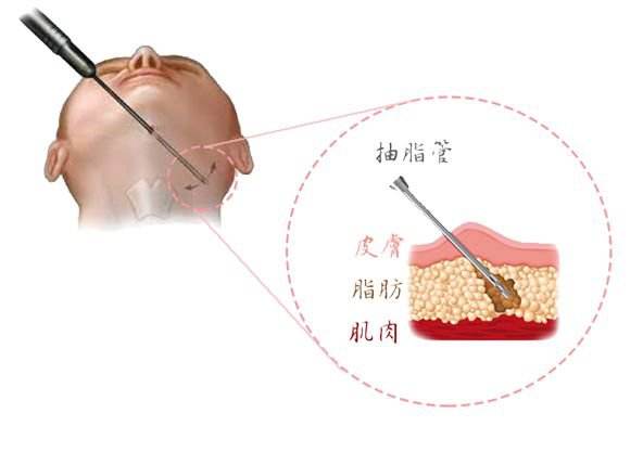 上海面部吸脂手术原理科普