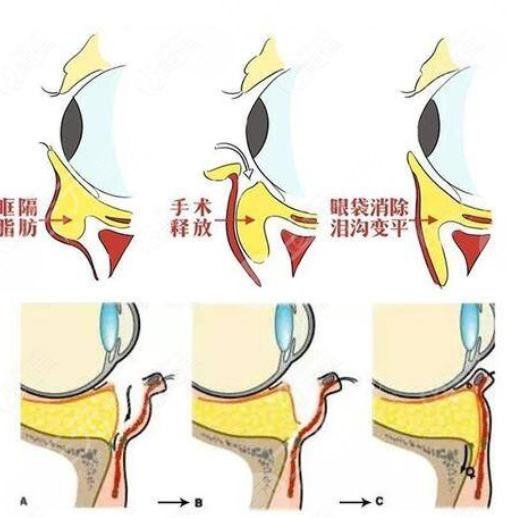 眶隔释放祛眼袋