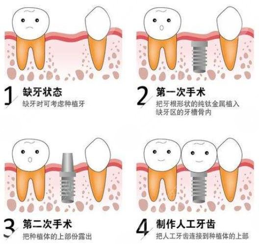 牙齿种植