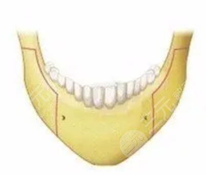 磨颧骨+下颌角整形5