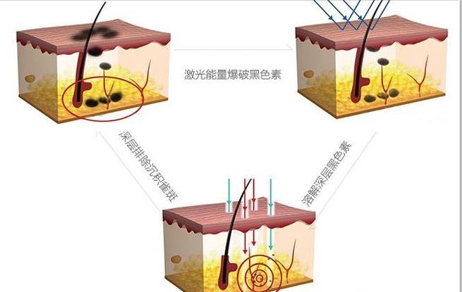 杭州市三院点痣价格表 附点痣原理及注意事项