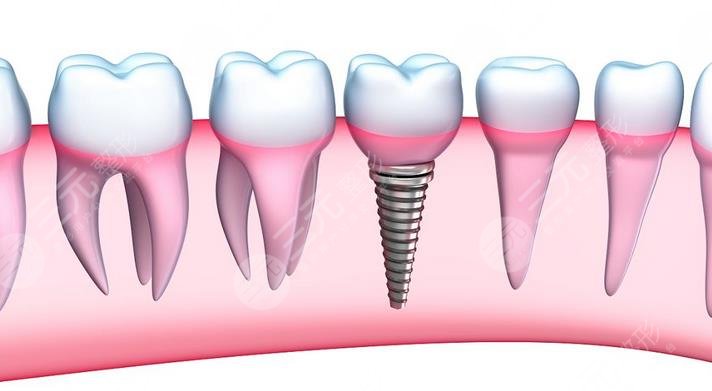 深圳第二人民医院种牙案例分享
