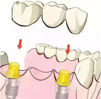 三水人民医院种植牙案例