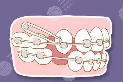 三水人民医院口腔科牙齿矫正案例