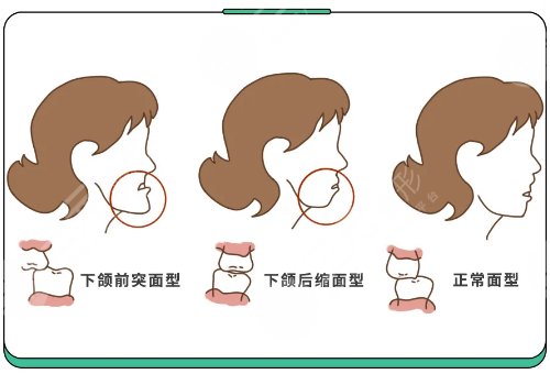 成都正颌手术医院排名更新