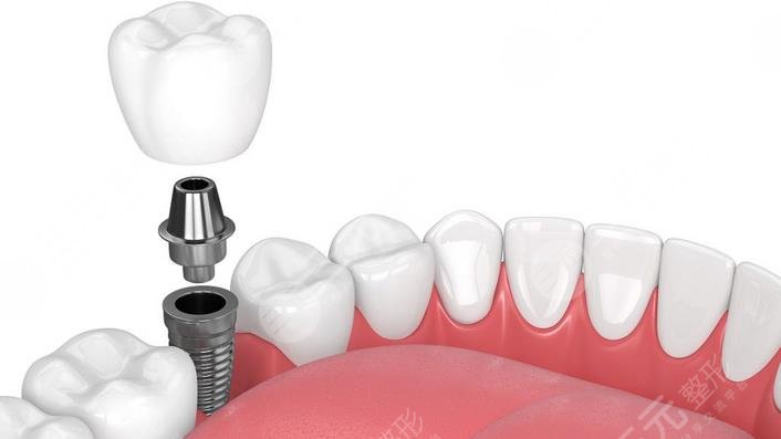 惠州第三人民医院种植牙案例