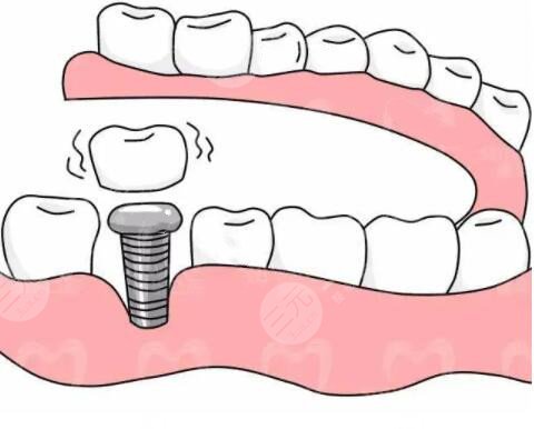 牙齿种植相关技术