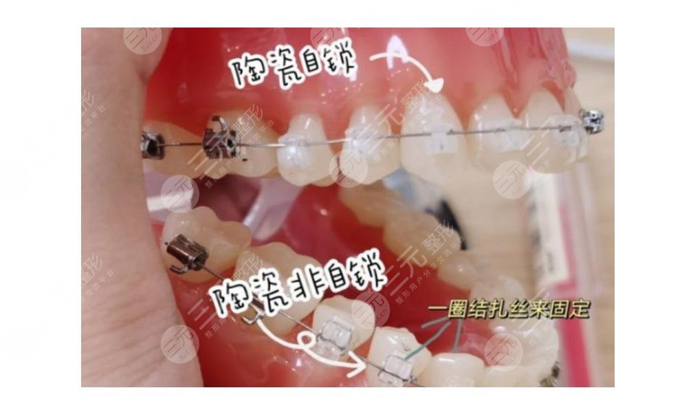 广州柏德种植牙质量和费用怎么样？