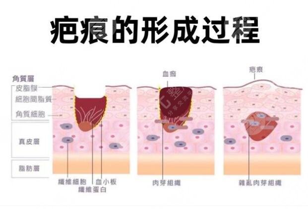 疤痕修复