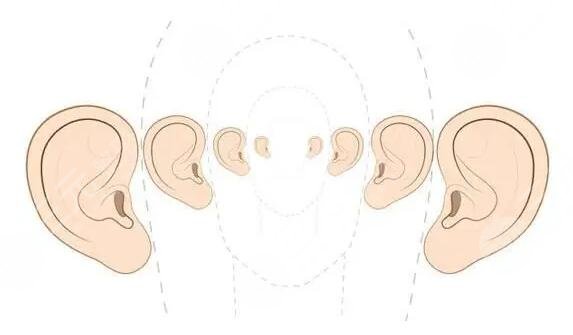耳朵矫正