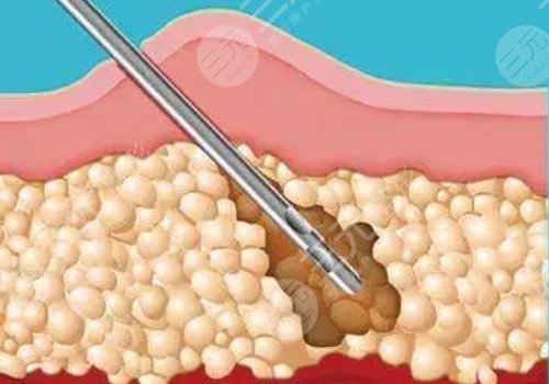 杭州华颜医疗美容医院吸脂怎么样?