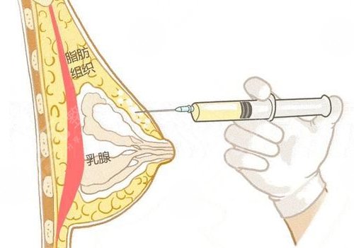 注射隆胸怎么取出来？