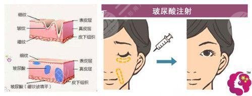 鼻基底注射玻尿酸后几天定型？