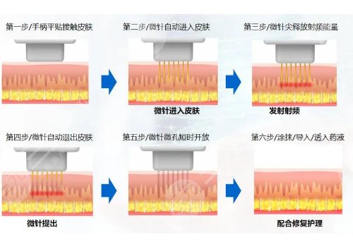 美迪迈黄金微针和半岛区别