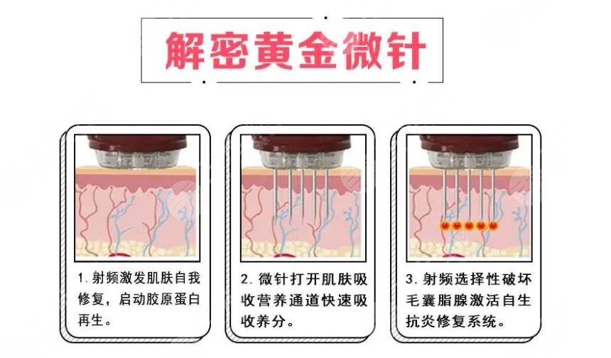 美迪迈黄金微针和半岛区别