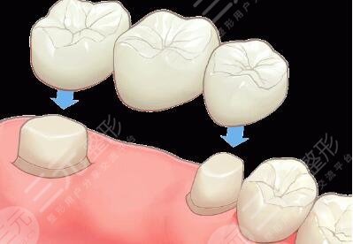 烤瓷牙修复能美白牙齿吗？多少钱？使用寿命是几年？