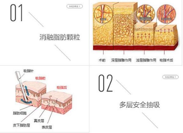 男人肚子吸脂肪多少钱？腹部抽脂价格表汇总，3家正规医院可选！