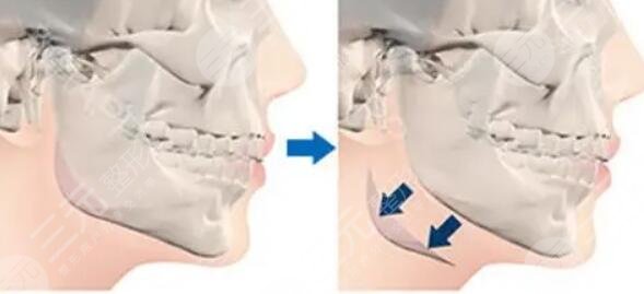 宽下颌角整形的基本原理