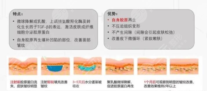 艾维岚注射后多久消肿