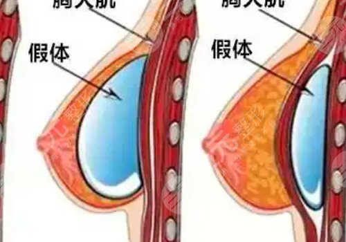 假体丰胸如何快速消肿？