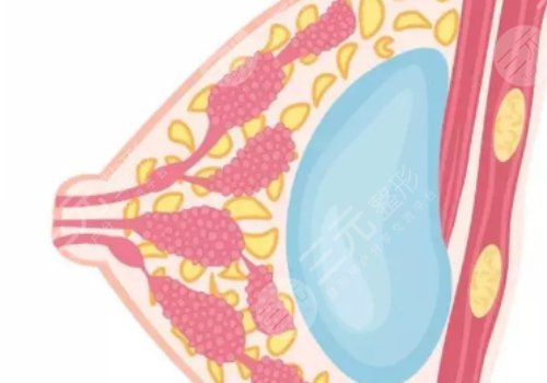 假体丰胸如何快速消肿？
