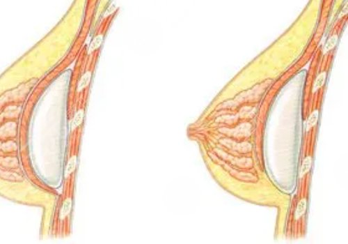 假体丰胸如何快速消肿？