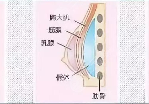 艾尔建假体好吗？