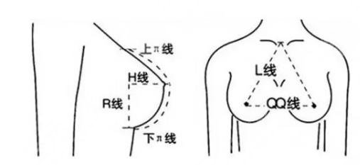 曼托丰胸