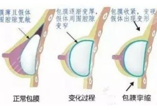 毛面假体包膜挛缩概率大吗？