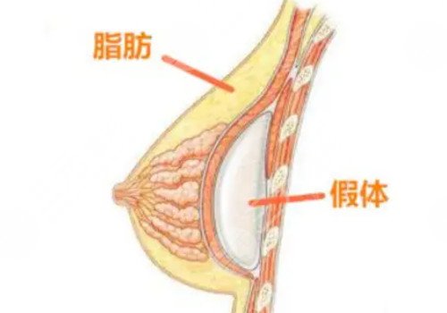 法国伊思雅胸假体多少钱？