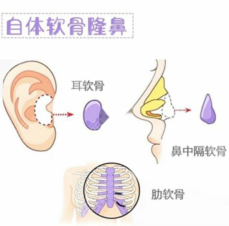 耳软骨垫鼻尖能维持几年？