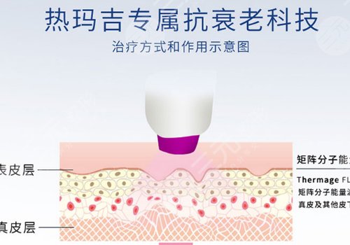 双cwt热玛吉与普通热玛吉什么区别？