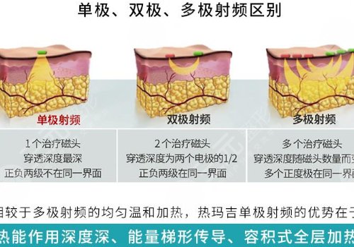 双cwt热玛吉与普通热玛吉什么区别？