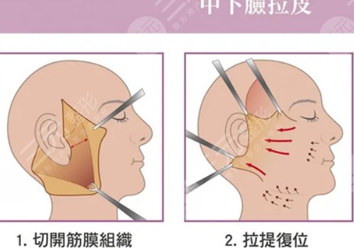 拉皮手术多大年龄做合适？