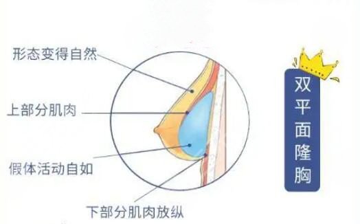 魔滴假体隆胸多少年更换?