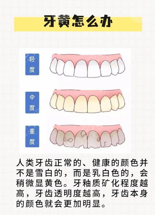 牙齿发黄变白的方法有哪些