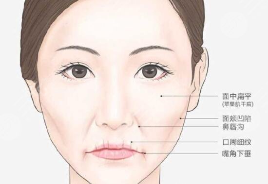 口角囊袋下面部松弛下垂