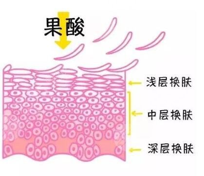 果酸换肤的副作用多久会显现出来?