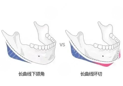 周会喜正颌手术做的怎么样?